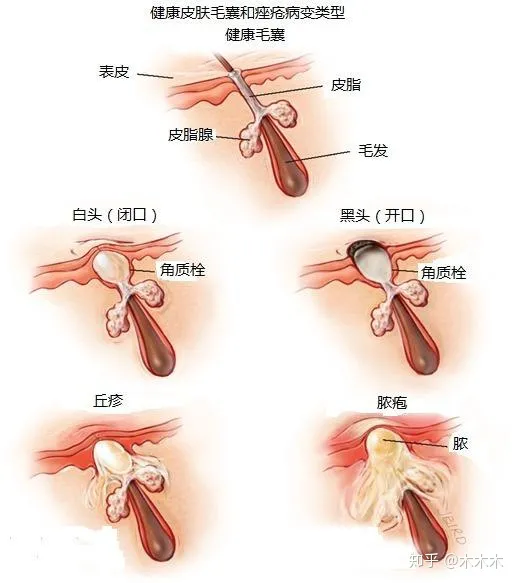 痤疮的天敌：揭示三个有效的土方法治疗痤疮