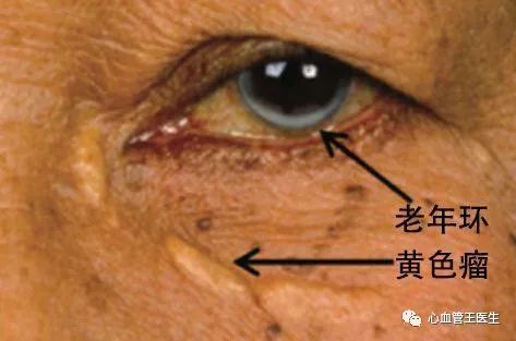 血脂高脸部症状：看脸辨别高血脂征兆