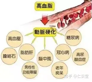 血脂高警示信号：两处疼痛暗示血脂问题