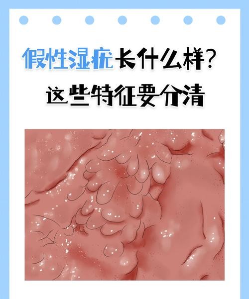 假性阴尖锐湿疣：别被名字吓到，这才是真相！