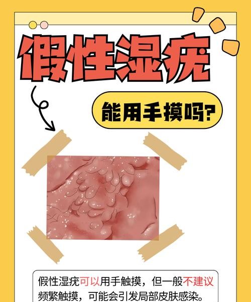假性阴尖锐湿疣：别被名字吓到，这才是真相！