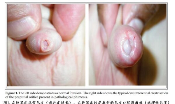 六个月宝宝包皮过长症状有哪些？新手爸妈必看指南！