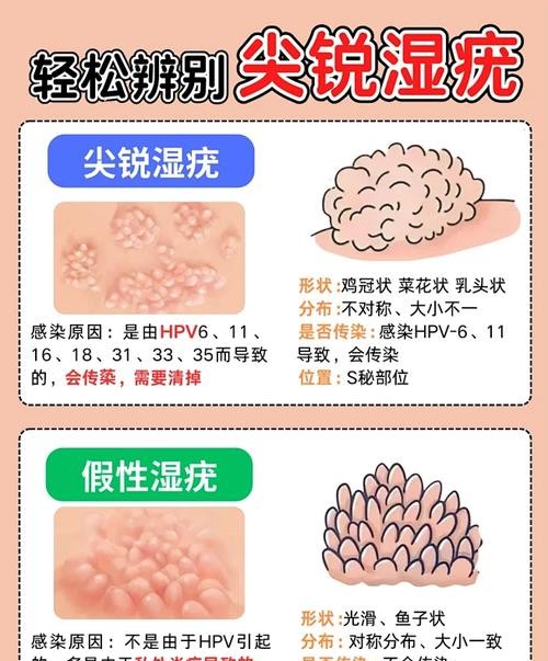 兰州尖锐湿疣治疗费用大概多少