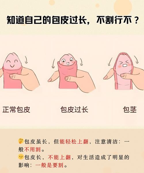 包皮过长不做手术没事吧？医生告诉你真相！