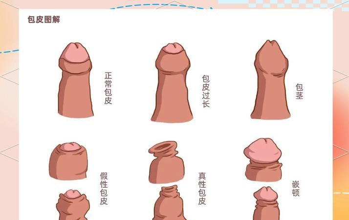包皮过长和包茎是什么样？一张图让你秒懂！