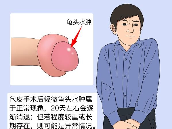 包皮过长术后肿正不正常?医生解答让你安心!