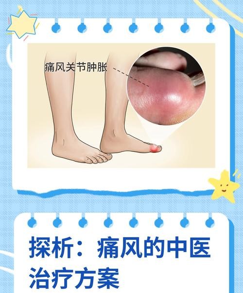 天津治疗痛风,这些方法让你告别疼痛!