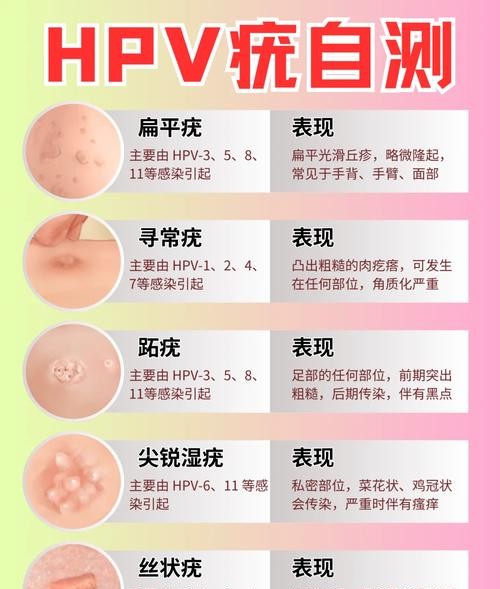 尖锐湿疣多久检查一次才安全?医生告诉你最佳时间