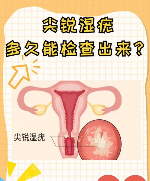 尖锐湿疣多久检查一次才安全?医生告诉你最佳时间