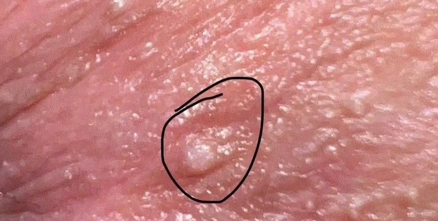 尖锐湿疣发白是好转还是恶化？医生揭秘真相