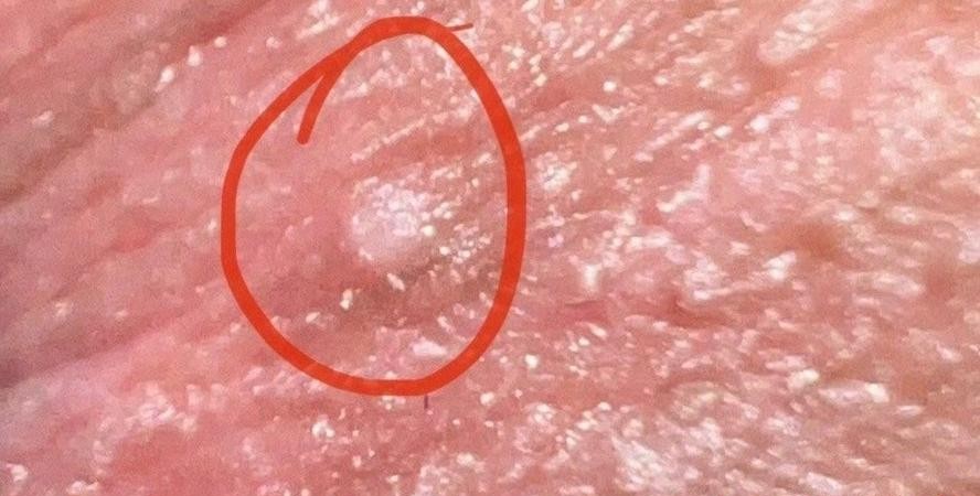 尖锐湿疣发白是好转还是恶化？医生揭秘真相