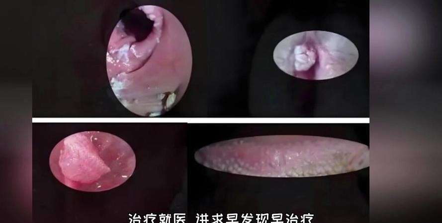 尖锐湿疣无症状，这些隐藏信号你必须知道！