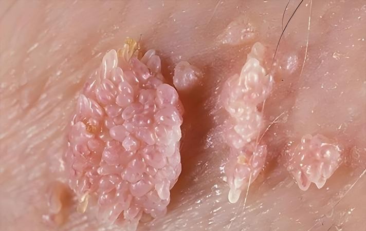 尖锐湿疣痘痘傻傻分不清？专家教你3招轻松辨别