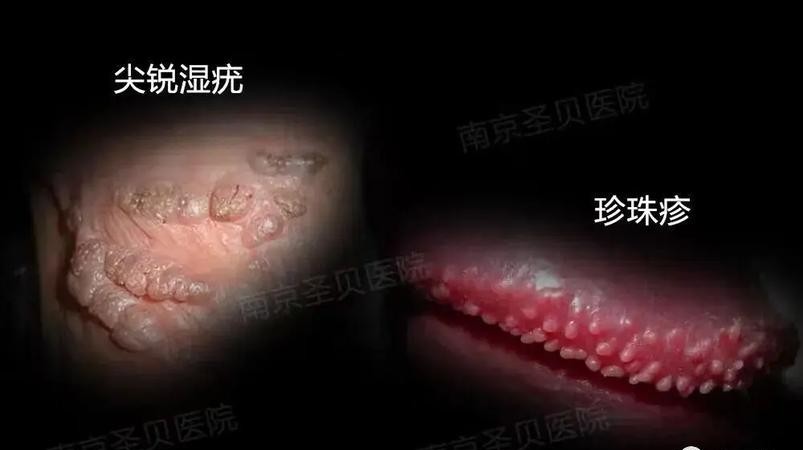 阴茎根部尖锐湿疣：这些症状你必须知道