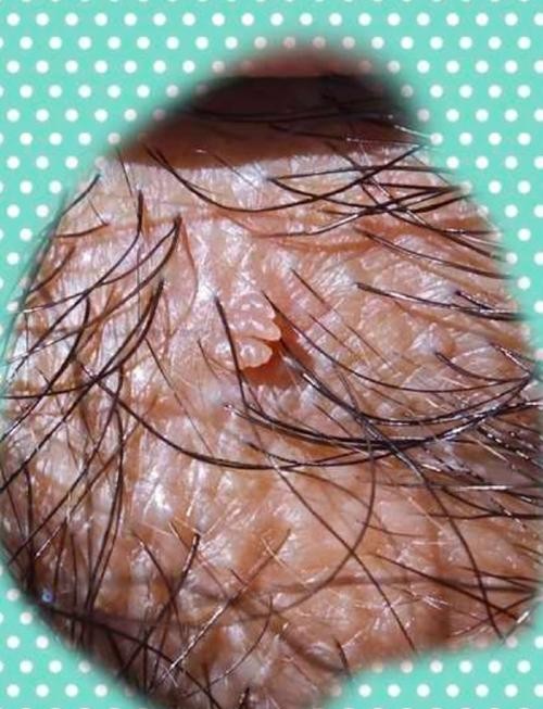 【高清图】尖锐湿疣真实照片曝光,医生教你一眼识别!