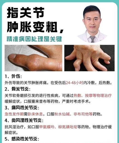 手指痛风快速消肿止痛方法