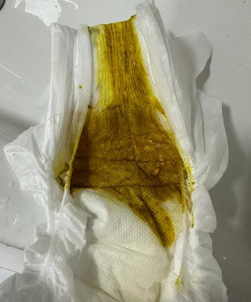 拉肚子半个月了？别慌！可能是这些原因在作祟
