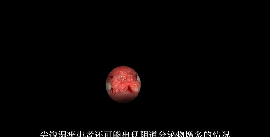 警惕!无症状尖锐湿疣正在悄悄蔓延