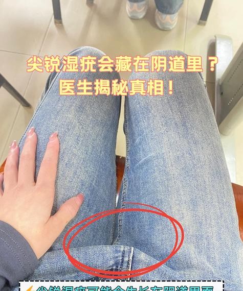 洗手后如何预防尖锐湿疣传播