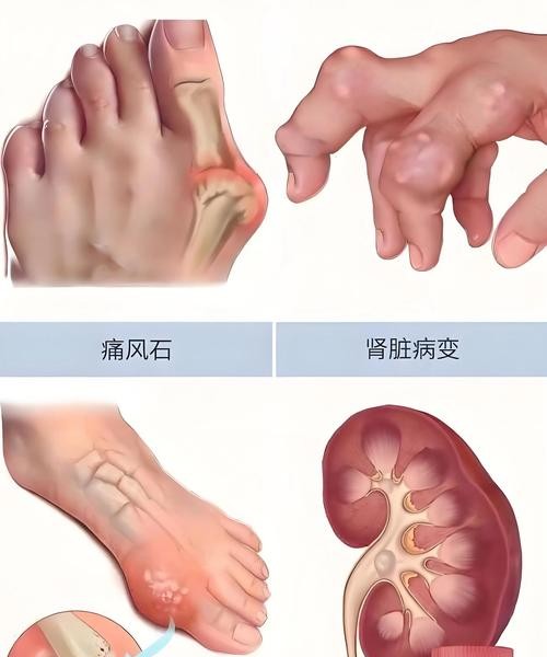 痛风460尿酸值严重超标怎么办