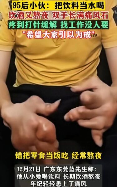 痛风喝汽水，小心尿酸飙升！