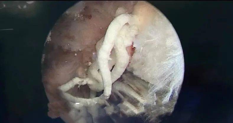 痛风挤牙膏？这招让你告别疼痛！