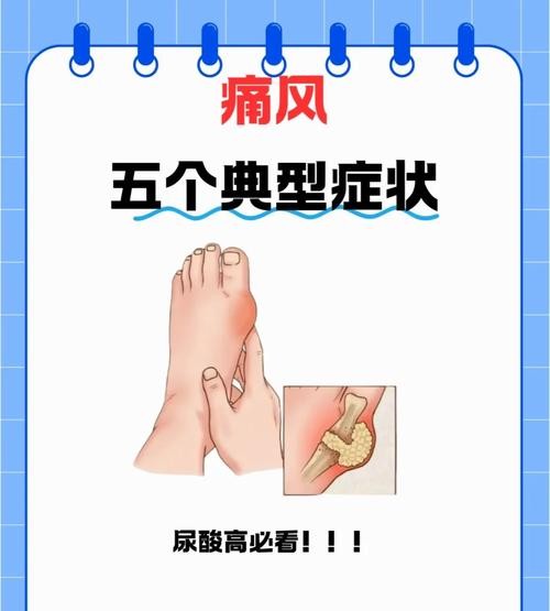 痛风病症大揭秘：这些症状你中招了吗？
