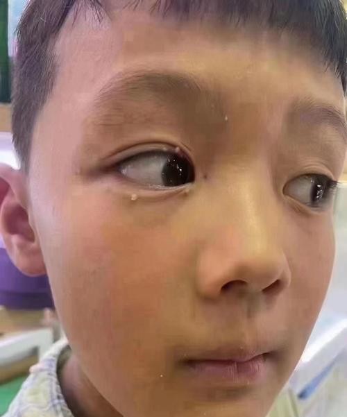 眼睛尖锐湿疣：眼部健康不容忽视的警示信号