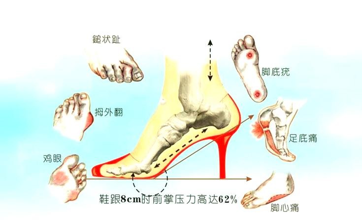 穿高跟鞋危害大揭秘！这5个后果你绝对想不到