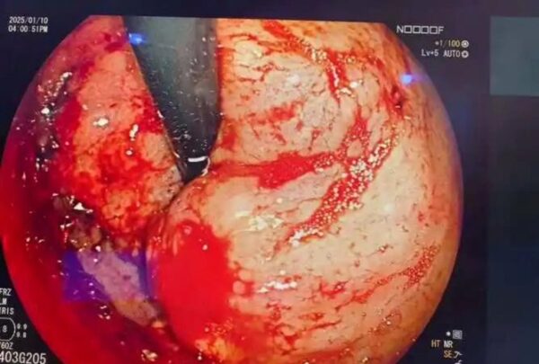 胃出血痛风患者必看！这些饮食禁忌你一定要知道