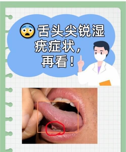 舔尖锐湿疣的惊人后果，医生警告千万别这样做！