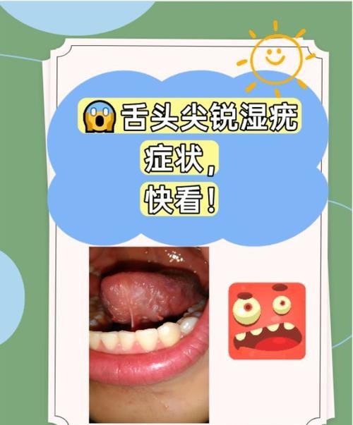 舔尖锐湿疣的惊人后果,医生警告千万别这样做!