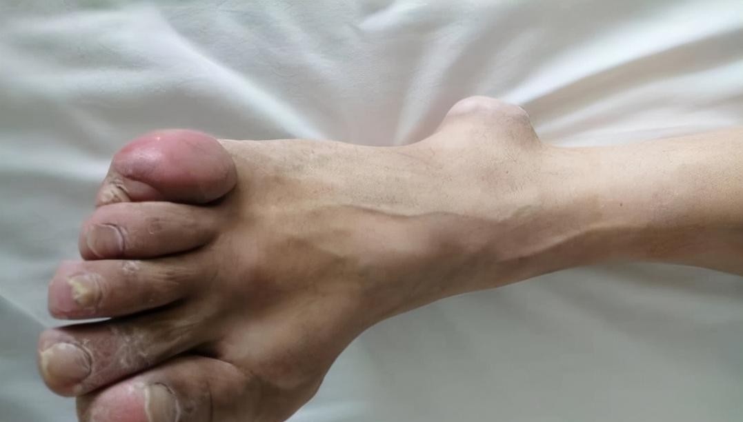 便秘痛风别硬扛！3招教你轻松缓解