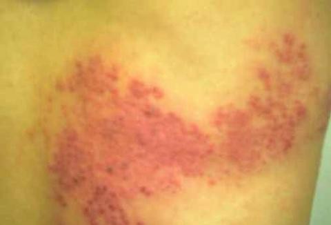 包皮过长竟会引发生殖器疱疹？这些预防措施你必须知道！