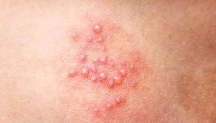 包皮过长竟会引发生殖器疱疹？这些预防措施你必须知道！