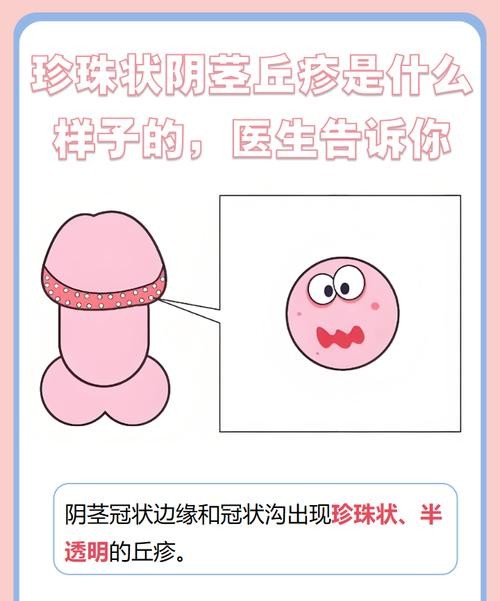 包皮过长会得尖锐湿疣吗？医生揭秘真相！