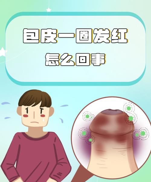 包皮过长引起的并发症，你了解几个？