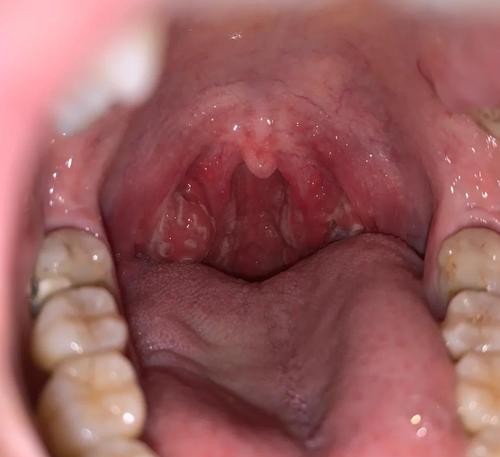 喉咙发炎拉肚子？这些症状背后隐藏的健康秘密！