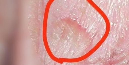 大连尖锐湿疣患者必看：这些治疗误区千万别踩！