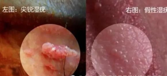 大连尖锐湿疣患者必看：这些治疗误区千万别踩！