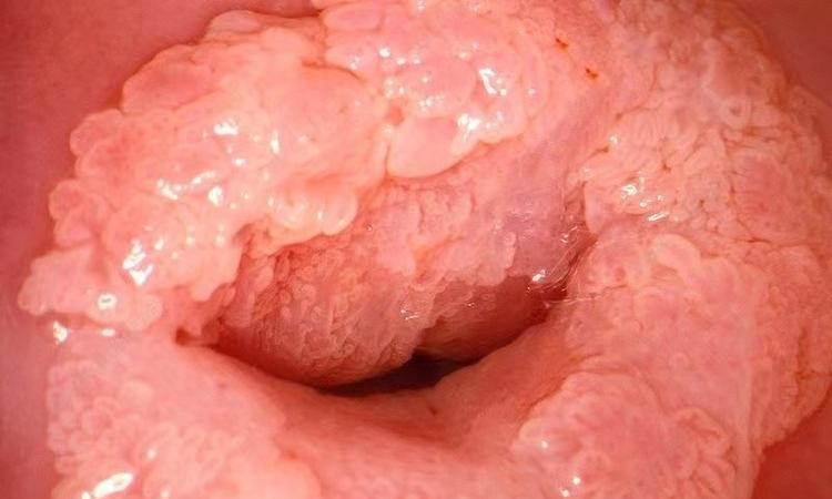 大连尖锐湿疣：这些早期症状千万别忽视！