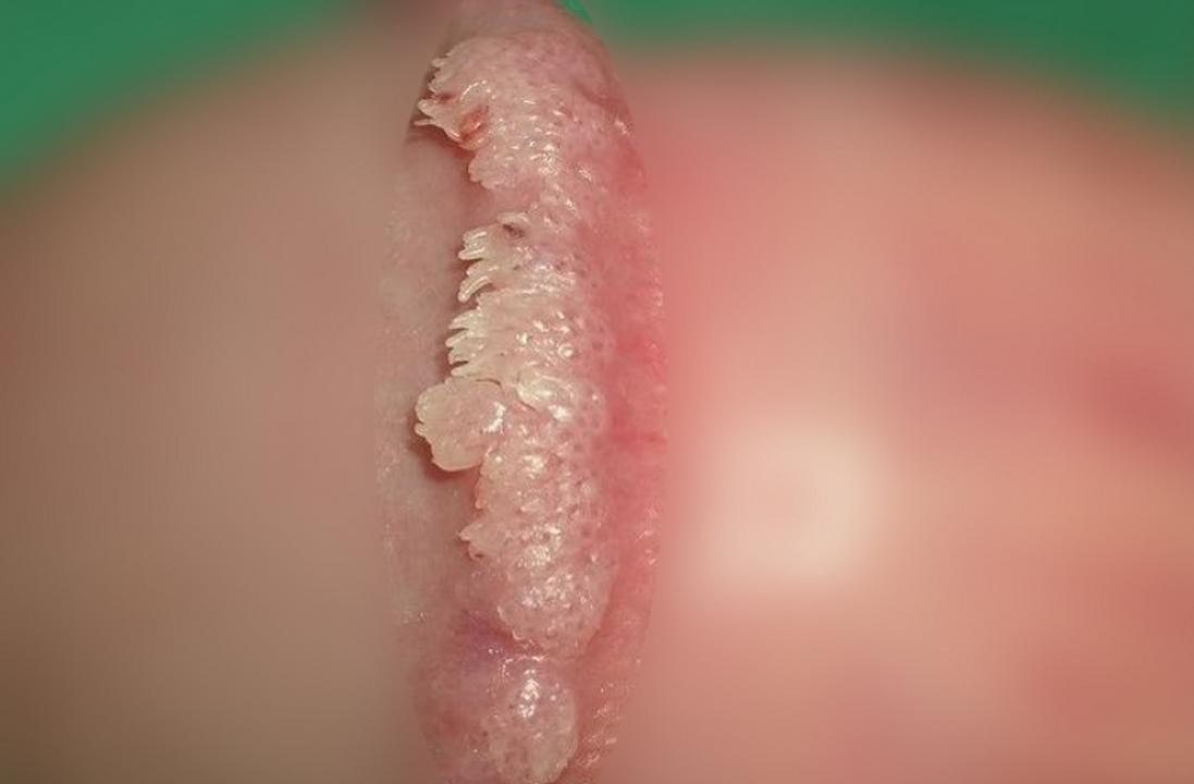 真实案例！女尖锐湿疣图片女患者自述治疗全过程