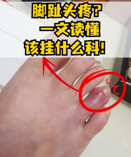 小脚趾头疼是痛风吗？这5个症状帮你快速判断！