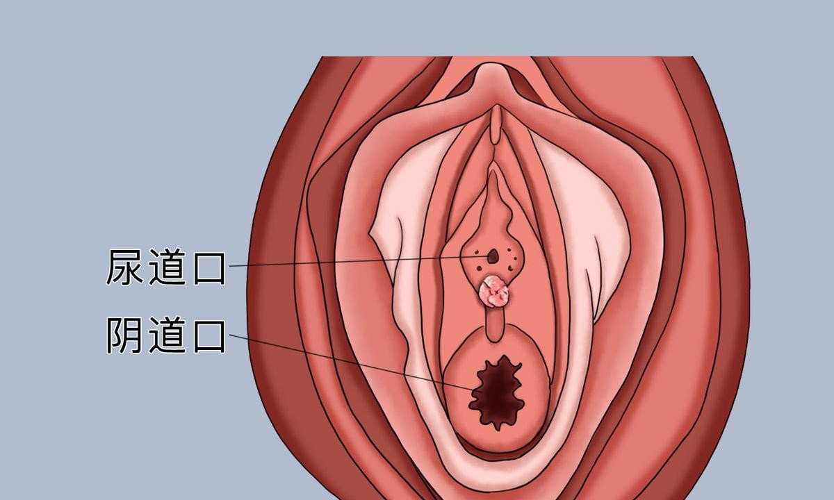 尖锐湿疣长在哪些位置最危险？这些症状你一定要知道！