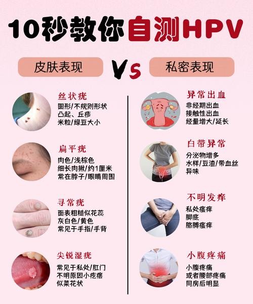 尖锐湿疣如何检测？这5种方法让你快速确诊！