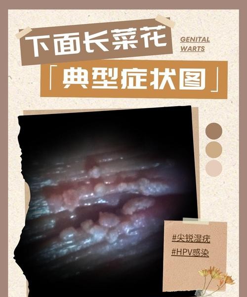 尖锐湿疣无症状，这些隐藏信号你注意到了吗？