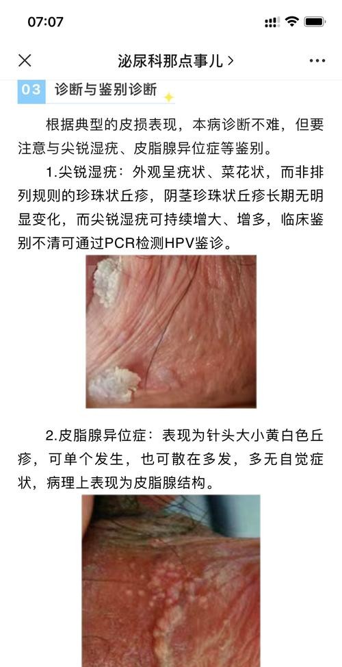 “尖锐湿疣”还是“痘痘”？别搞混了，这些区别必须知道！