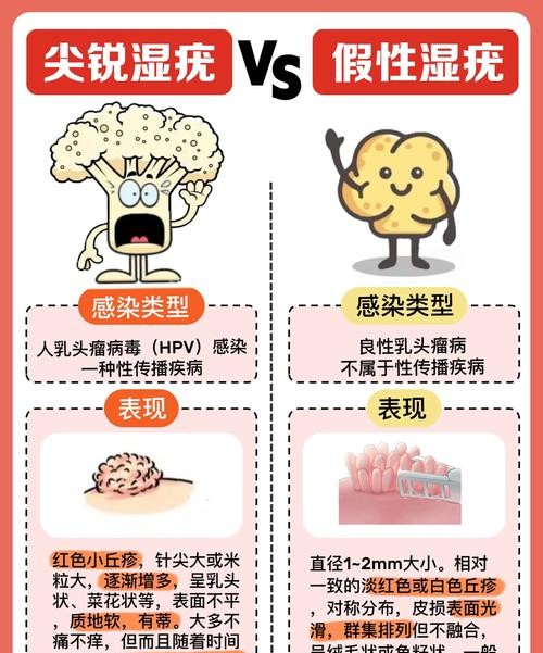 尖锐湿疣全过程：从感染到治愈的完整记录