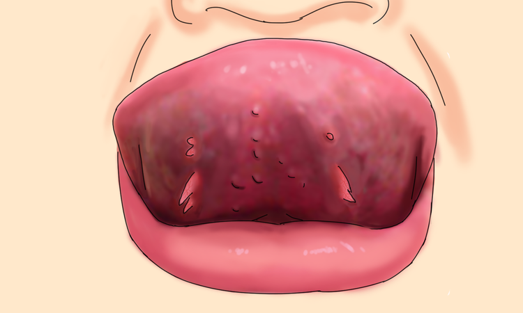 尖锐湿疣会出血？这5个危险信号千万别忽视！