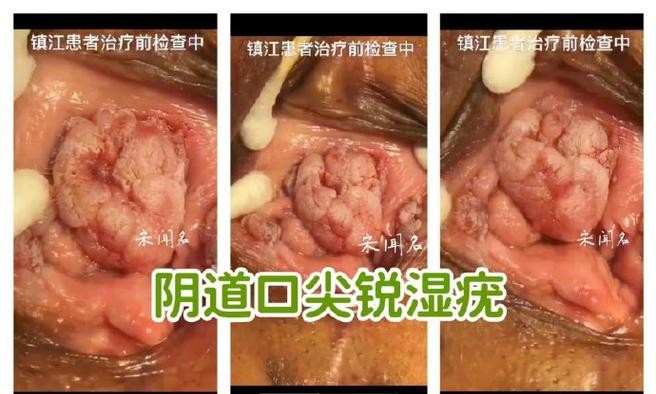 尖锐湿疣会出血？这5个危险信号千万别忽视！